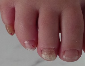 toenail problems fungus. nail disease. Stock fénykép Shutterstock - PuzzlePix
