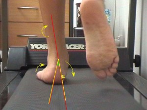 flat_feet_pronation_podiatry_care_gait_analysis