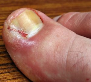 ingrown toe nails