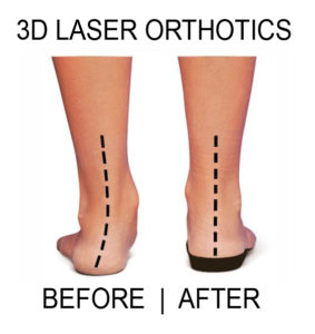 flat-feet-pronation-before-and-after-orthotics